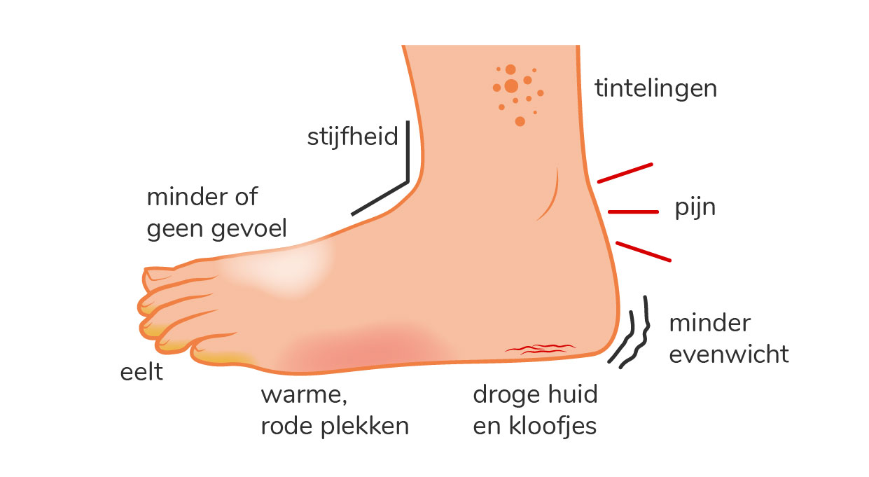 De diabetische voet is een naam voor een aantal problemen, bijvoorbeeld wondjes die slecht genezen.