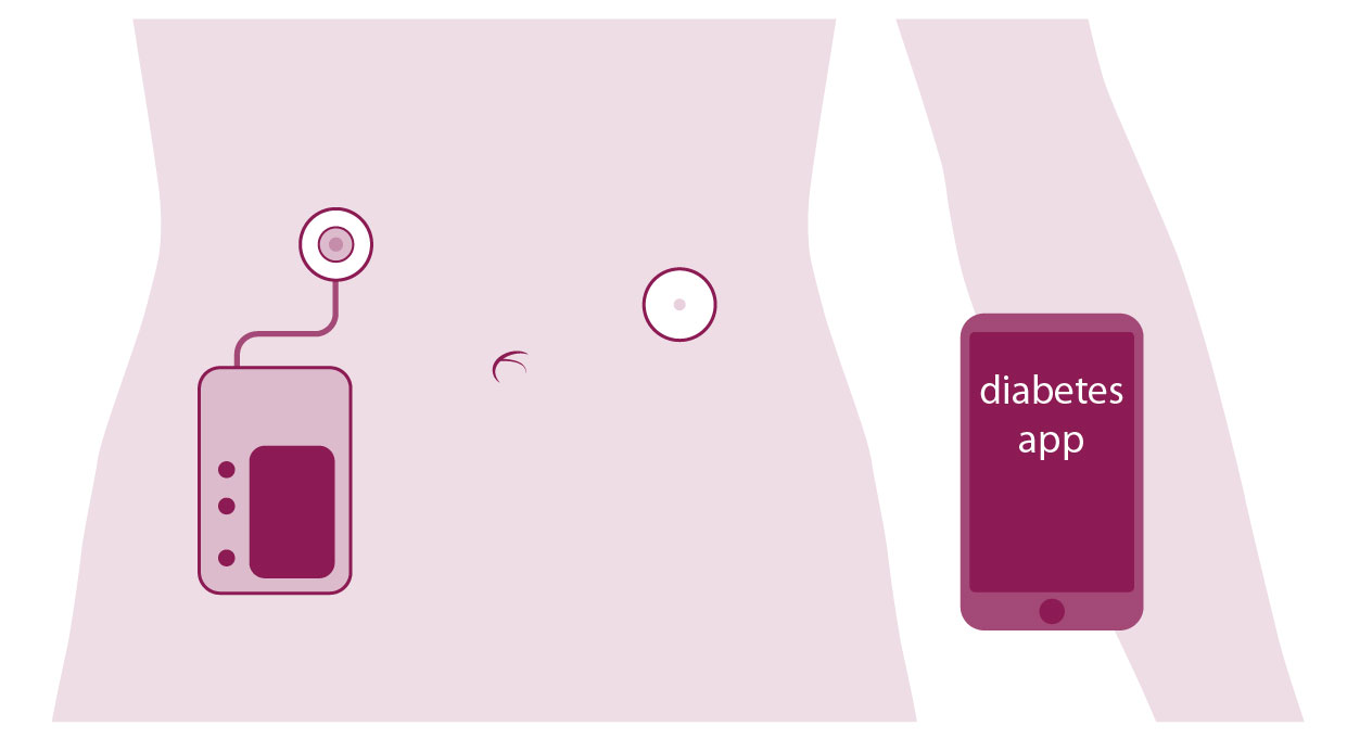 Glucosesensoren en hybrid closed loop systemen   diabetes.nl