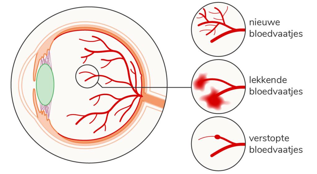 Door diabetes kunnen kleine bloedvaatjes in het netvlies zwakker worden. Dat heet retinopathie.