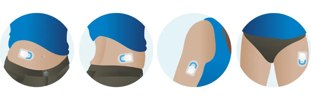 Illustratie van 4 plekken voor een patchpomp