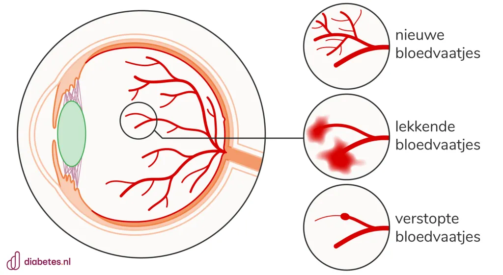 Tekening die laat zien hoe de bloedvaatjes in het oog zwakker worden bij diabetes