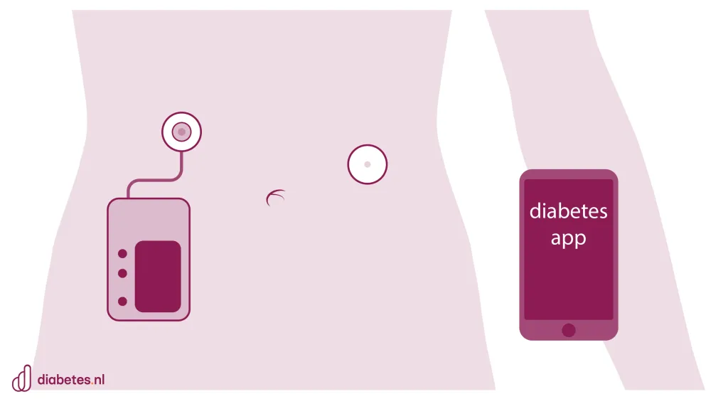 Tekening met uitleg over een een hybrid closed loop. Dit is een combinatie van een continue glucosesensor en een insulinepomp.
